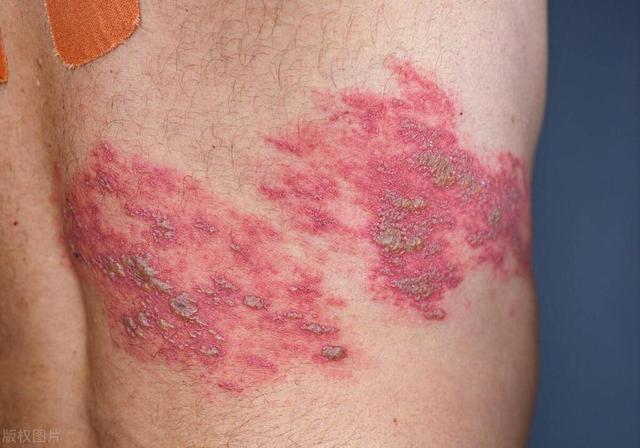 蛇盘疮的症状有哪些图片